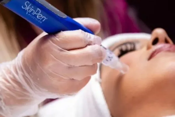 Microneedling